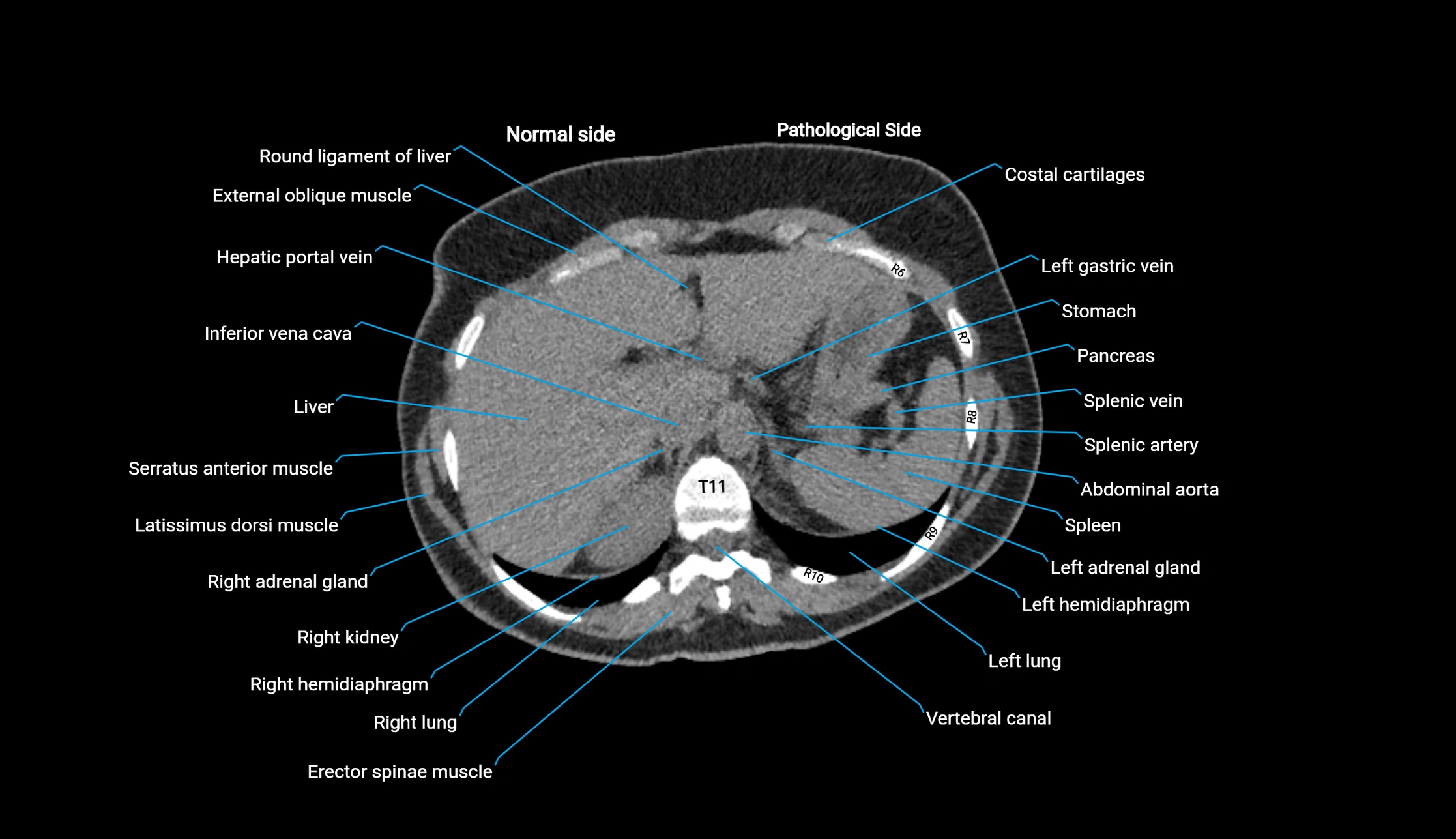 CT KUB axial cross sectional anatomy  radiology image -img-00201-00014.webp